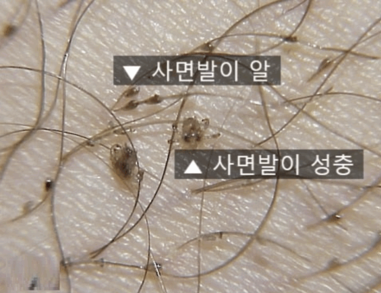 사면발이 사진